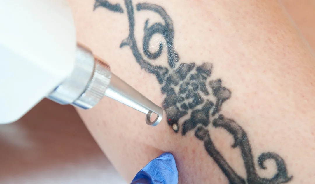 A Professional performing Laser Tattoo Removal in Baldwinsville, NY, using advanced laser equipment to safely fade unwanted tattoo ink from a client’s skin.