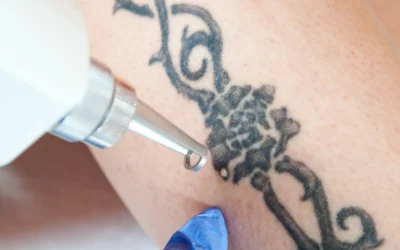 How Laser Tattoo Removal Works: A Complete Guide