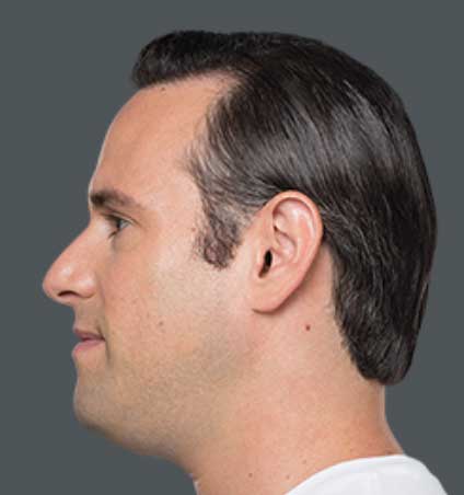 Kybella-before-img