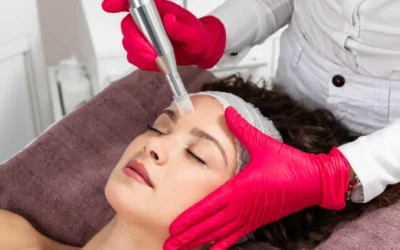 Microneedling for Acne Scars: Does It Really Help?